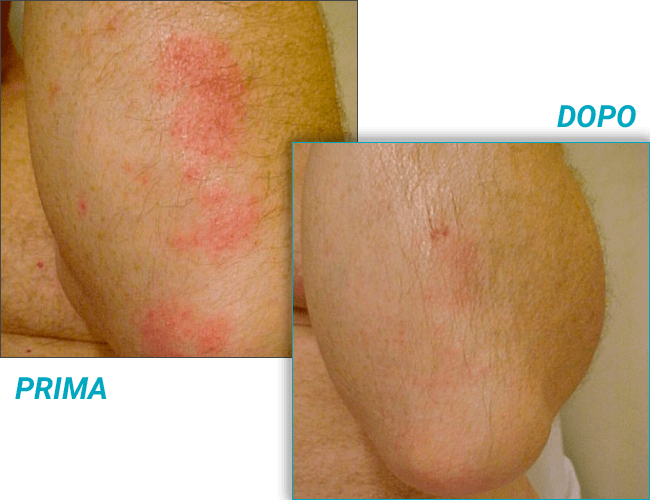 Psorisolv  Crema Psoriasi